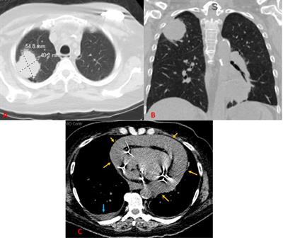 Would the Addition of Immunotherapy Impact the Prognosis of Patients With Malignant Pericardial Effusion?
